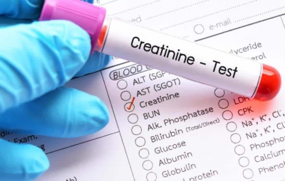 آزمایش Creatinine چیست؟