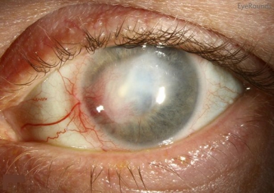 بیماری کراتیت چشم