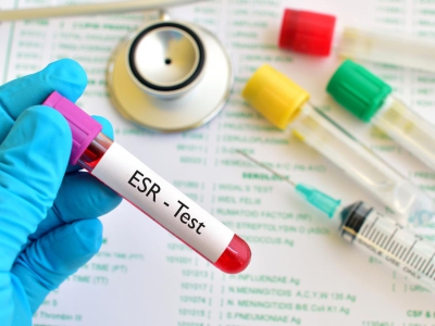 اهمیت آزمایش ESR‌ و چگونگی تاثیر بیماری های مختلف در میزان آن